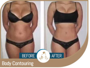 Before and After Gallery of True Laser Spa in Saint Clair Shores, MI Before and After Gallery of True Laser Spa in Saint Clair Shores, MI