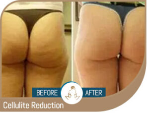 Before and After Gallery of True Laser Spa in Saint Clair Shores, MI Before and After Gallery of True Laser Spa in Saint Clair Shores, MI