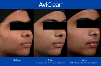 AviClear for Acne Treatment in Saint Clair Shores, MI AviClear for Acne Treatment in Saint Clair Shores, MI