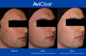 AviClear for Acne Treatment in Saint Clair Shores, MI AviClear for Acne Treatment in Saint Clair Shores, MI