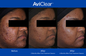 AviClear for Acne Treatment in Saint Clair Shores, MI AviClear for Acne Treatment in Saint Clair Shores, MI