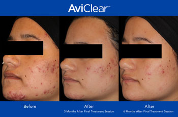 AviClear for Acne Treatment in Saint Clair Shores, MI AviClear for Acne Treatment in Saint Clair Shores, MI