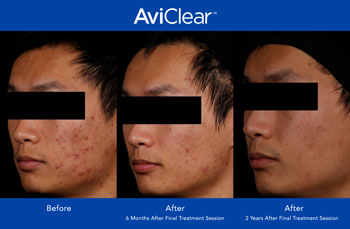 AviClear for Acne Treatment in Saint Clair Shores, MI AviClear for Acne Treatment in Saint Clair Shores, MI