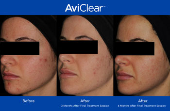 AviClear for Acne Treatment in Saint Clair Shores, MI AviClear for Acne Treatment in Saint Clair Shores, MI