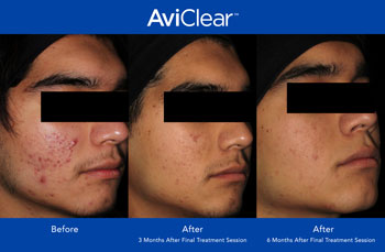 AviClear for Acne Treatment in Saint Clair Shores, MI AviClear for Acne Treatment in Saint Clair Shores, MI