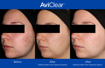 AviClear for Acne Treatment in Saint Clair Shores, MI AviClear for Acne Treatment in Saint Clair Shores, MI