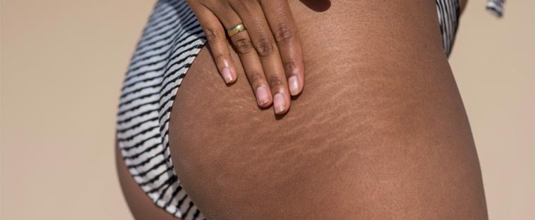 Stretch Marks Removal With Picoway Resolve Laser Near Me in Saint Clair Shores, MI Stretch Marks Removal With Picoway Resolve Laser Near Me in Saint Clair Shores, MI