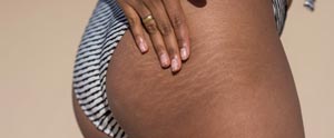 Stretch Marks Removal With Picoway Resolve Laser Near Me in Saint Clair Shores, MI Stretch Marks Removal With Picoway Resolve Laser Near Me in Saint Clair Shores, MI
