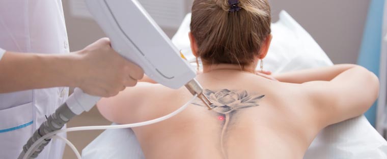 Tattoo Removal Near Me in Saint Clair Shores, MI Tattoo Removal Near Me in Saint Clair Shores, MI