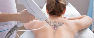 Tattoo Removal Near Me in Saint Clair Shores, MI Tattoo Removal Near Me in Saint Clair Shores, MI